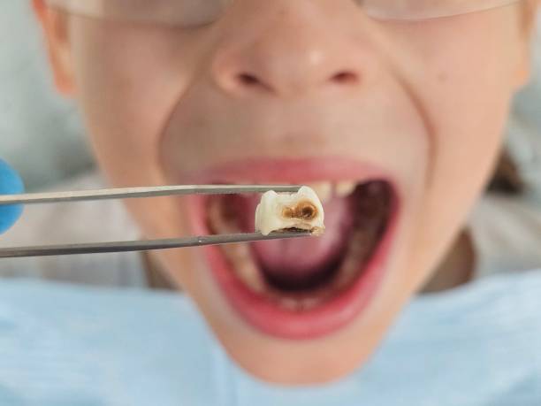 Best Emergency Dental Care for Abscessed Tooth in Berry College, GA
